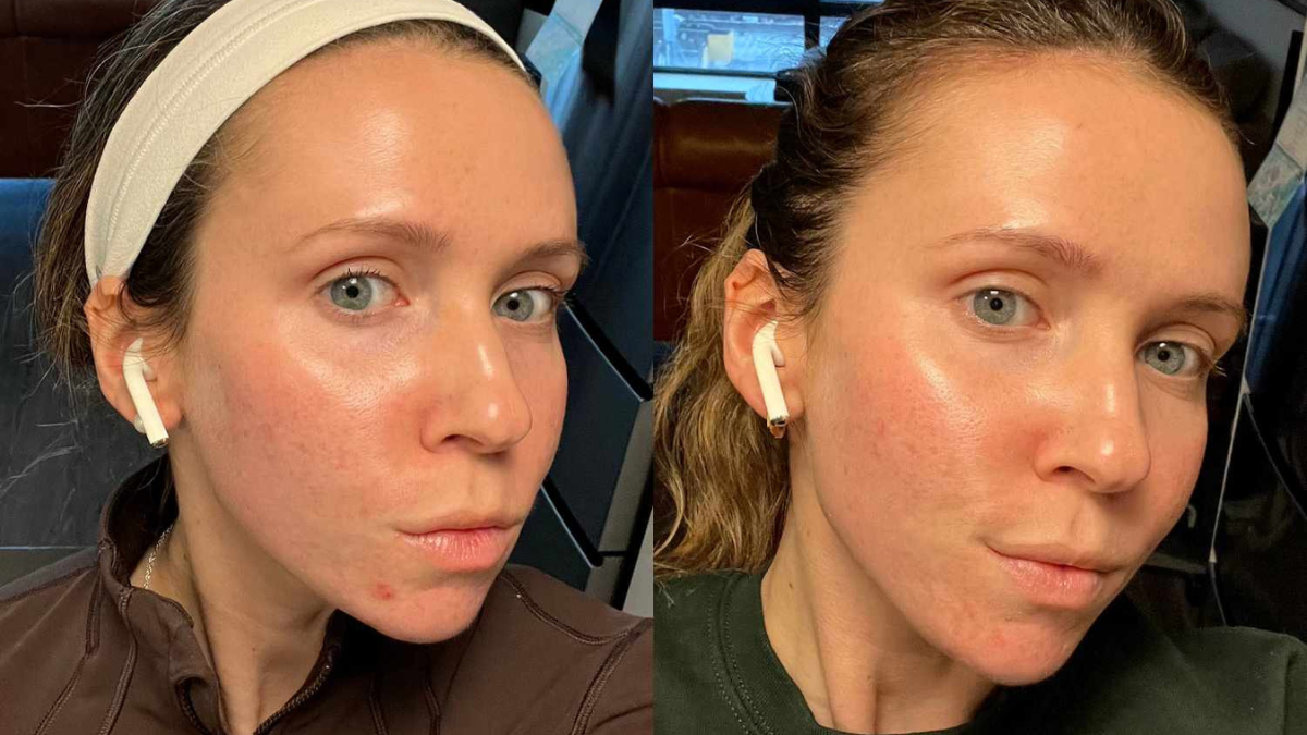 Pimple patch पिंपल से परेशान इस एज़ी और पेनलेस उपाय से पिंपल पैच लगाकर तुरंत पाएं चमकदार और क्लियर स्किन!