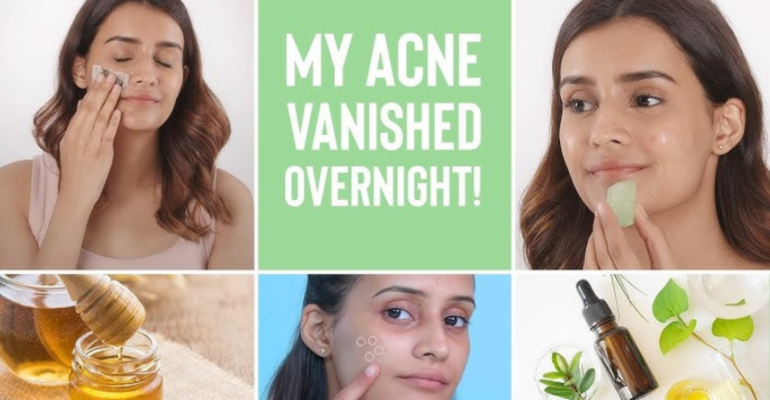 Acne squad : पूरी रेंज जो आपके पिंपल्स डार्क स्पॉट्स और ऑयली स्किन