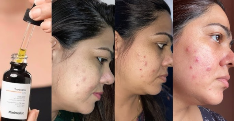 Minimalist Niacinamide Serum Minimalist नियासिनमाइड सीरम – आपकी त्वचा के लिए शक्तिशाली